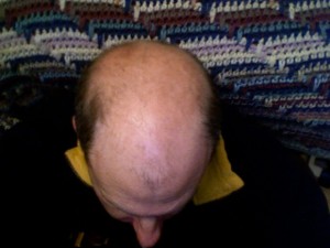Bald_head