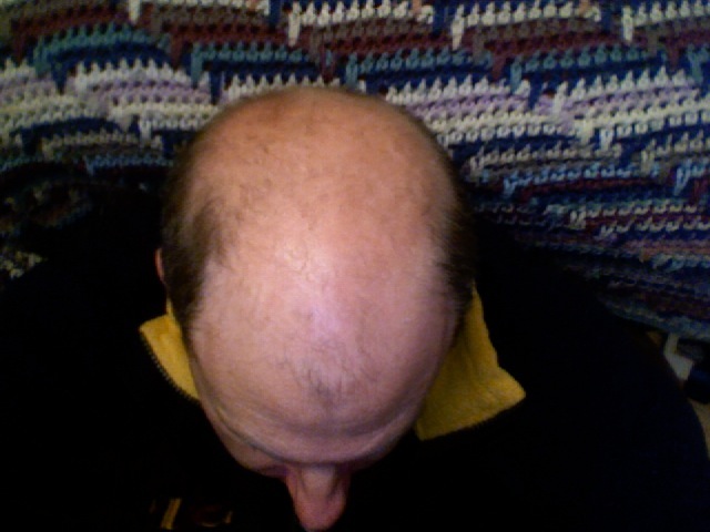 Bald_head